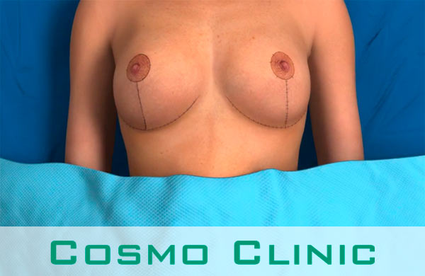 Scars after breast reduction