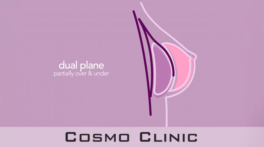 silicone implant, dual plane