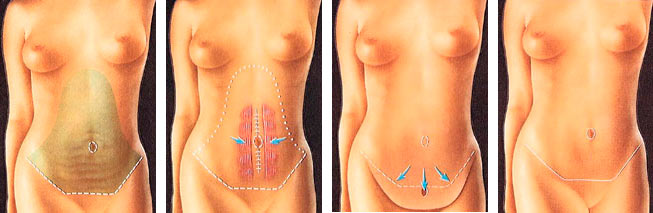 Scars after tummy tuck operation